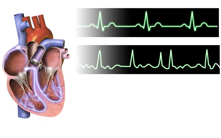 Medical illustration of a heart in atrial fibrillation, showing chaotic electrical signals in the atria compared with a normal heartbeat