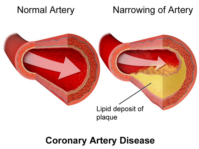 Medical illustration of coronary artery disease showing plaque build-up narrowing a coronary artery