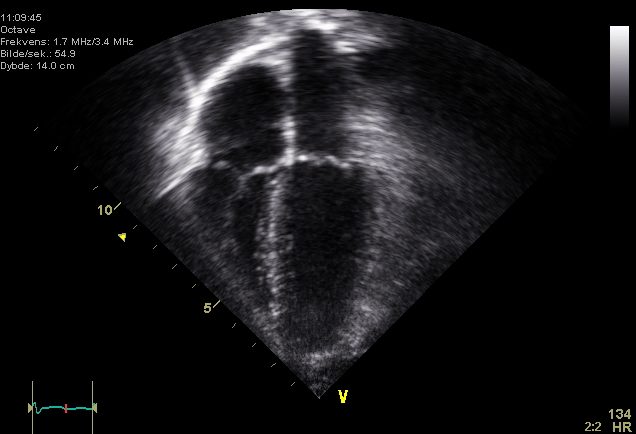 Apical four-chamber echocardiogram ultrasound image showing the four chambers of the heart