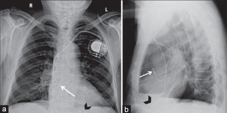 Chest X-ray showing an implanted pacemaker with leads in the right atrium and right ventricle